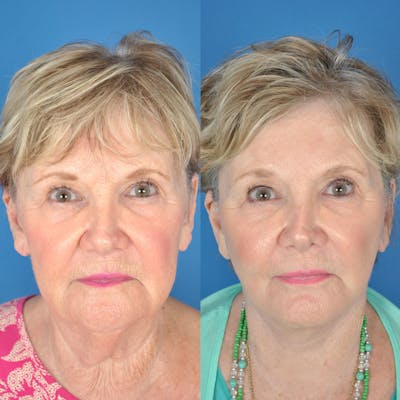 Facelifts Before & After Gallery - Patient 177570519 - Image 1