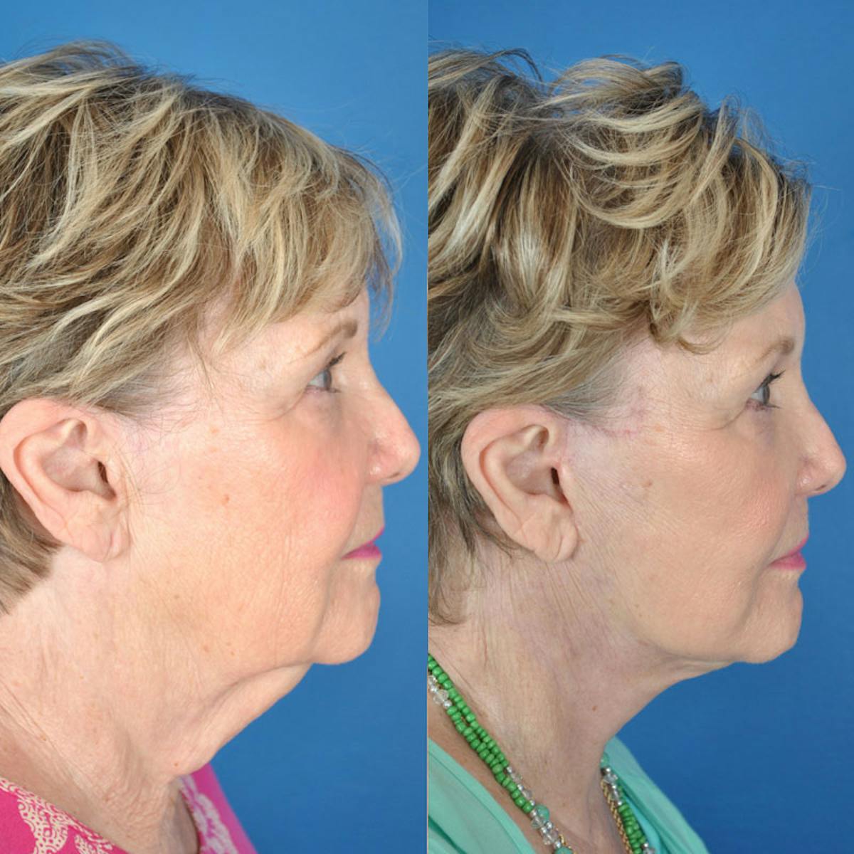 Facelifts Before & After Gallery - Patient 177570519 - Image 2