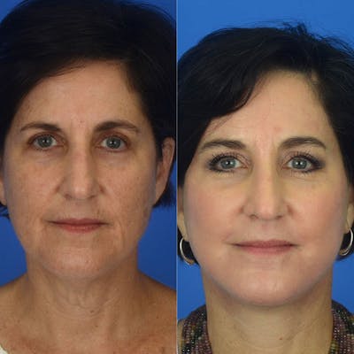 Facelifts Before & After Gallery - Patient 177570541 - Image 1