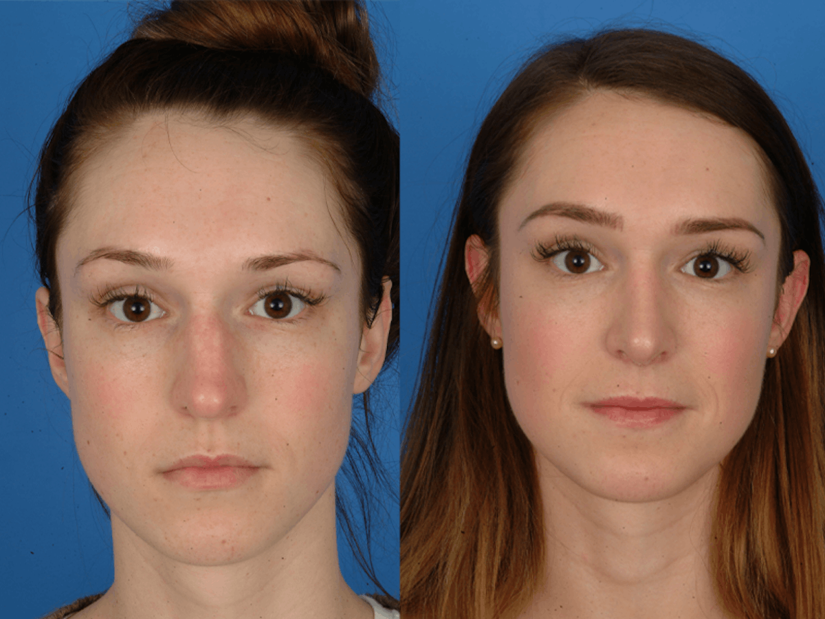 Rhinoplasty Before & After Gallery - Patient 177570544 - Image 2