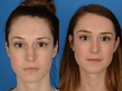 Rhinoplasty Before & After Gallery - Patient 177570544 - Image 1