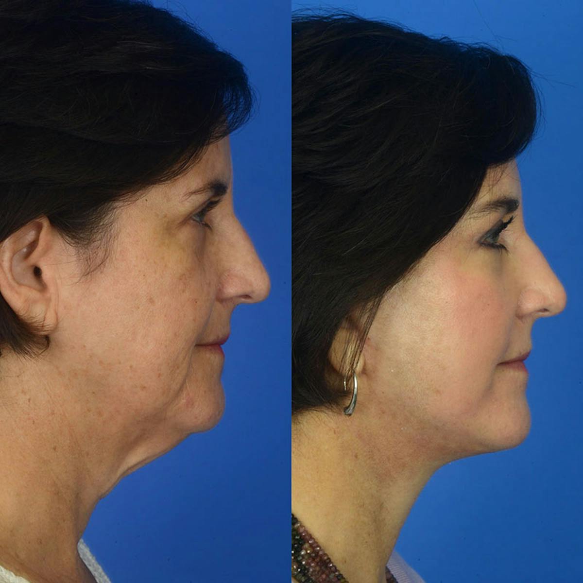 Facelifts Before & After Gallery - Patient 177570541 - Image 2