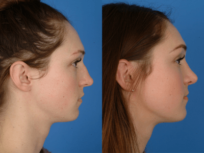 Rhinoplasty Before & After Gallery - Patient 177570544 - Image 1