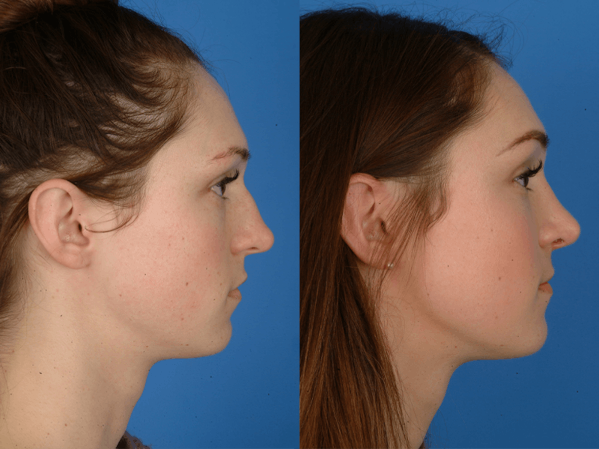 Rhinoplasty Before & After Gallery - Patient 177570544 - Image 2