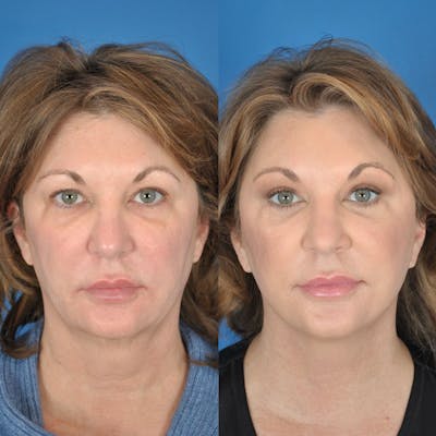 Facelifts Before & After Gallery - Patient 177570546 - Image 1