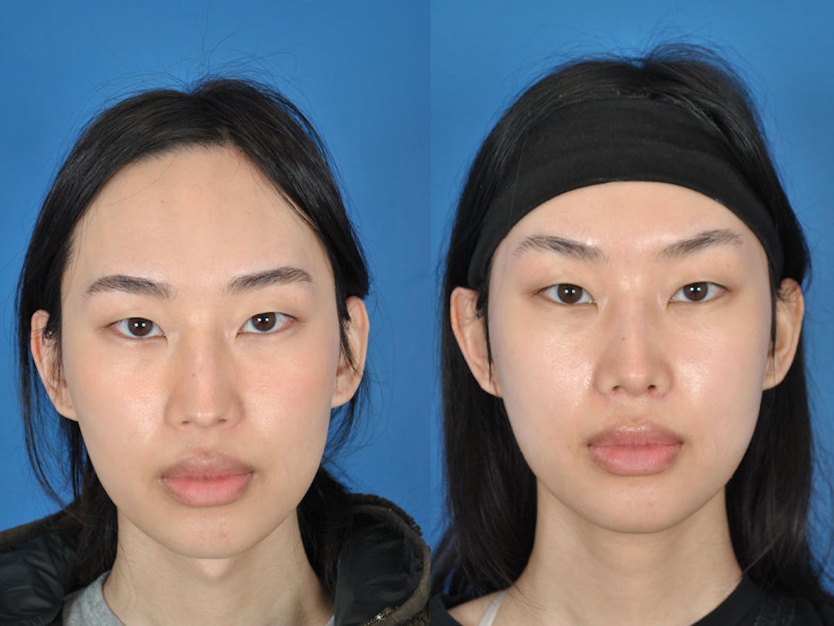 Rhinoplasty Before & After Gallery - Patient 177570549 - Image 2