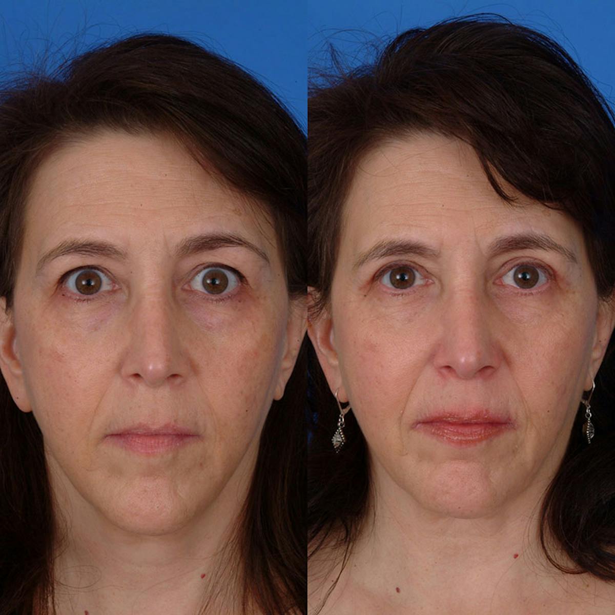 Eyelifts & Blepharoplasty Before & After Gallery - Patient 177570547 - Image 1