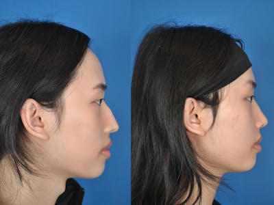 Rhinoplasty Before & After Gallery - Patient 177570549 - Image 1