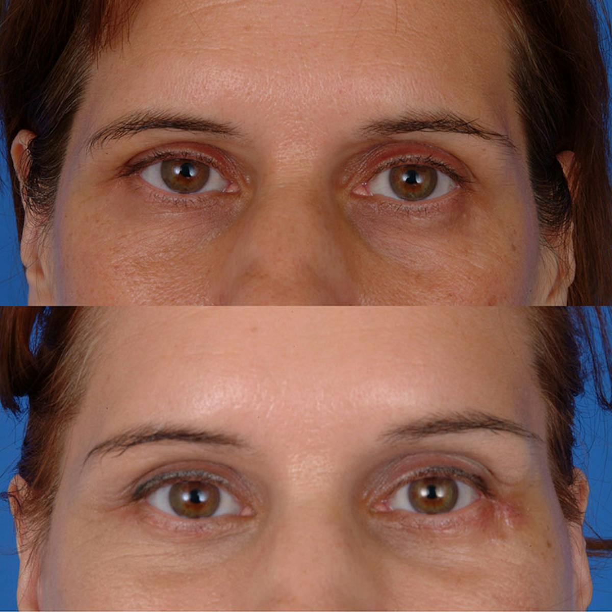 Eyelifts & Blepharoplasty Before & After Gallery - Patient 177570547 - Image 2