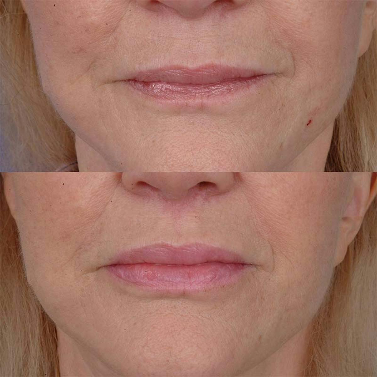Lip Lifts Before & After Gallery - Patient 177570550 - Image 1