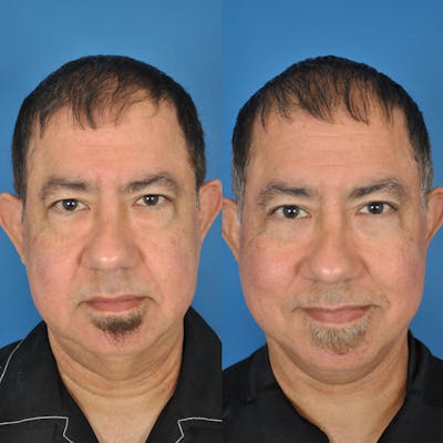 Facelifts Before & After Gallery - Patient 177570551 - Image 1