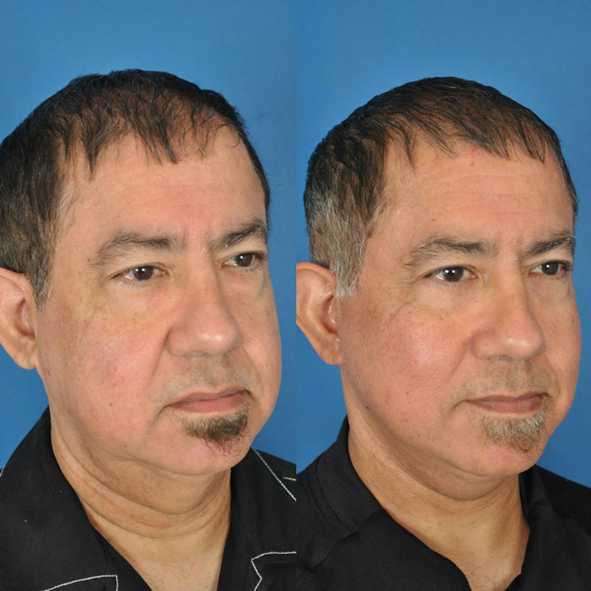 Facelifts Before & After Gallery - Patient 177570551 - Image 2