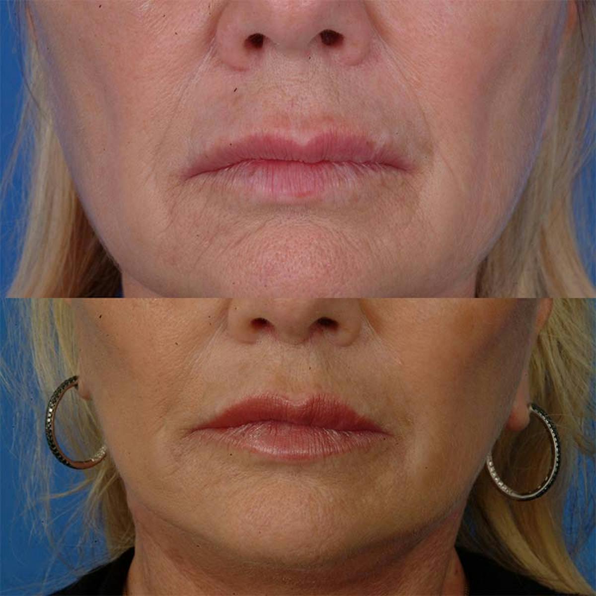 Lip Lifts Before & After Gallery - Patient 177570550 - Image 2