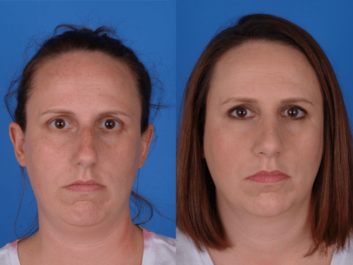 Rhinoplasty Before & After Gallery - Patient 177570558 - Image 2