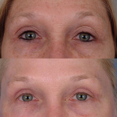 Eyelifts & Blepharoplasty Before & After Gallery - Patient 177570557 - Image 1