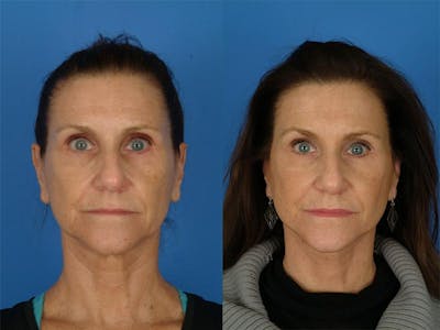 Facelifts Before & After Gallery - Patient 177570559 - Image 1