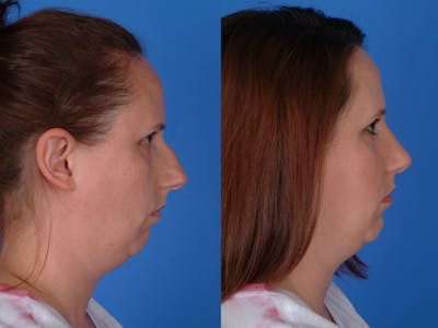 Rhinoplasty Before & After Gallery - Patient 177570558 - Image 1
