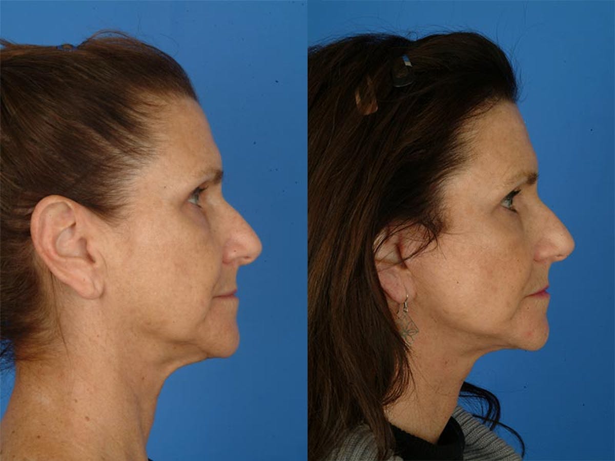 Facelifts Before & After Gallery - Patient 177570559 - Image 2