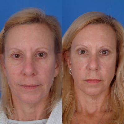 Eyelifts & Blepharoplasty Before & After Gallery - Patient 177570560 - Image 1