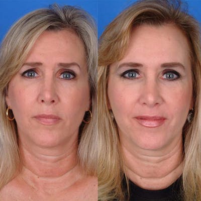 Brow Lifts Before & After Gallery - Patient 177570561 - Image 1
