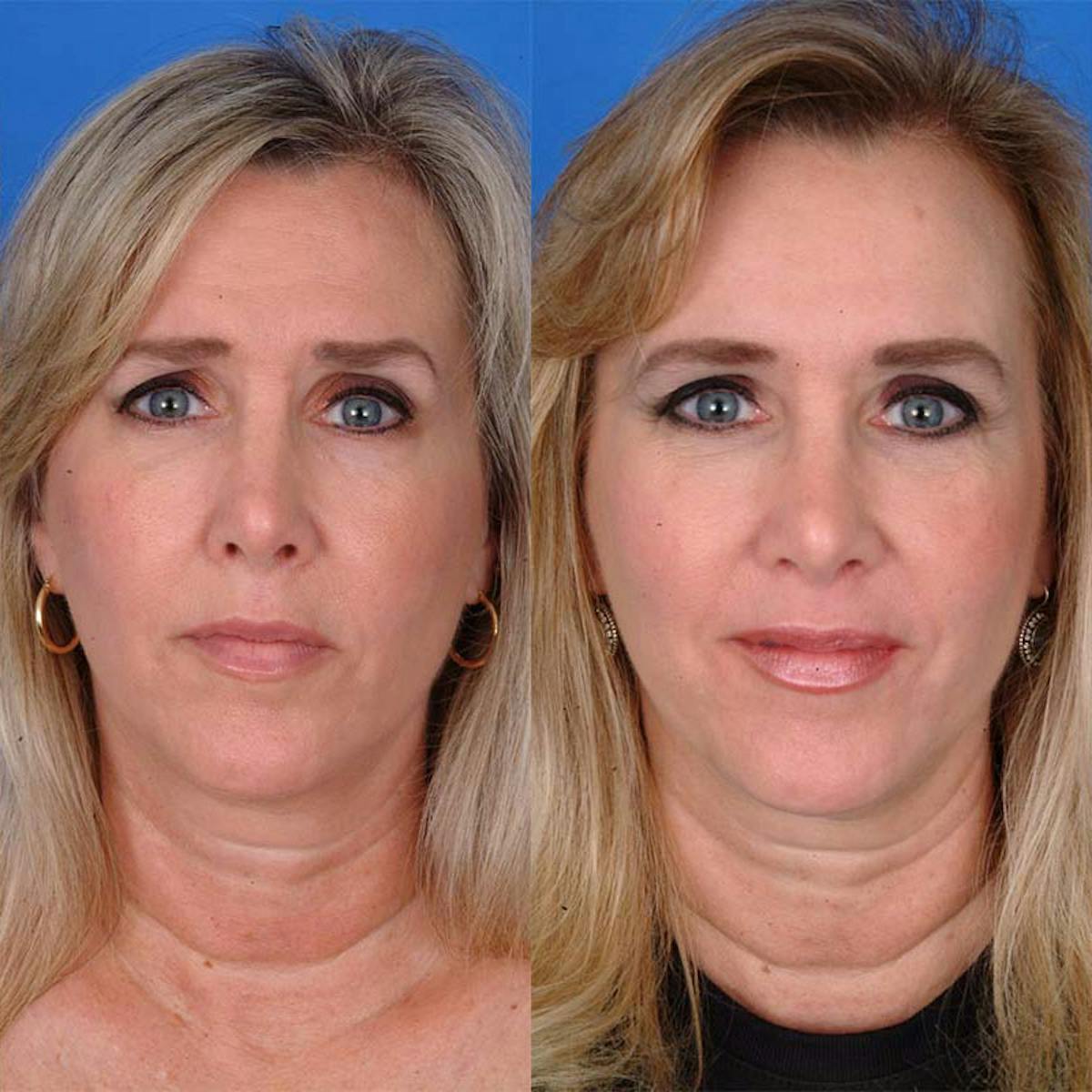 Brow Lifts Before & After Gallery - Patient 177570561 - Image 1