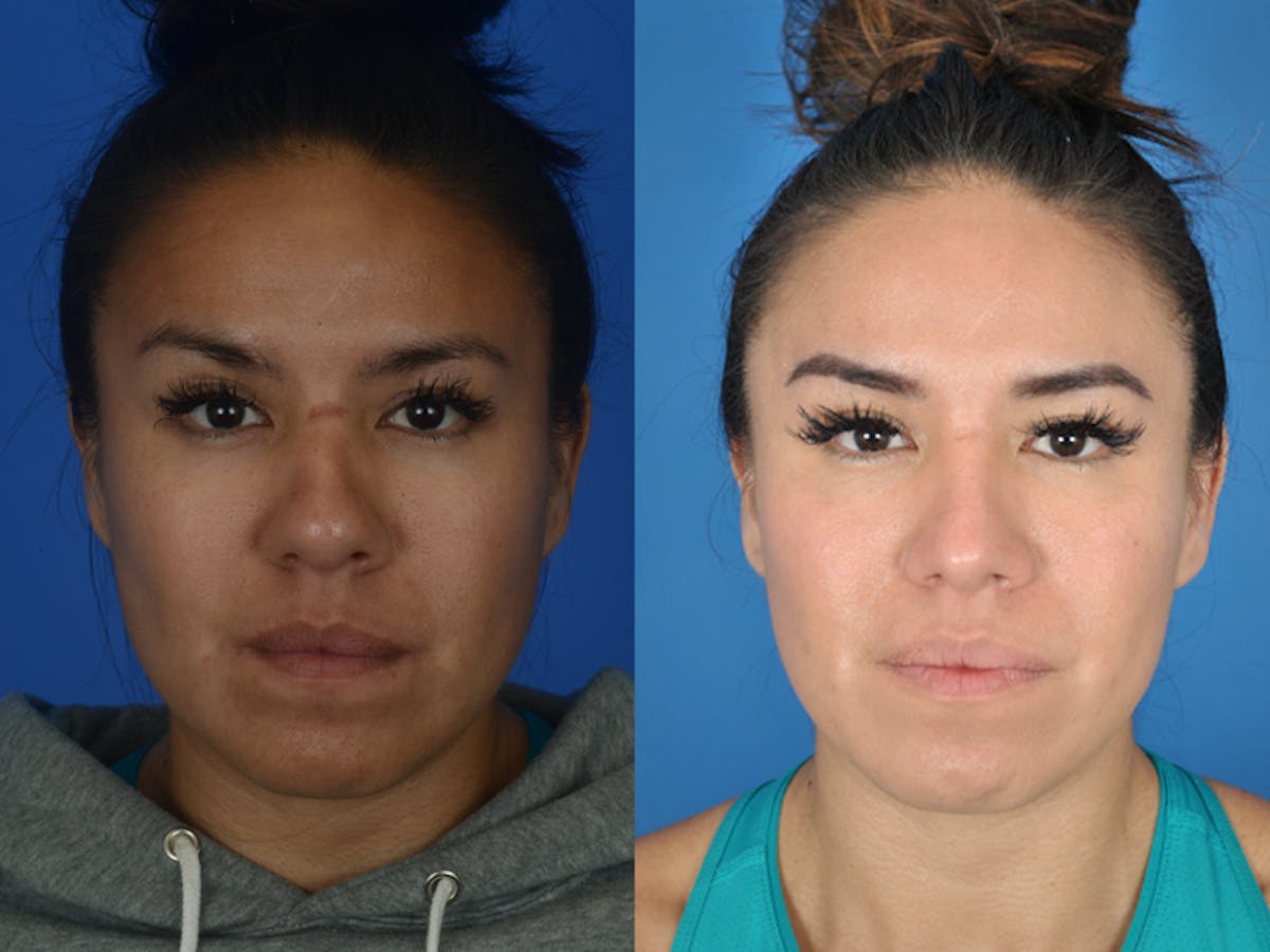 Rhinoplasty Before & After Gallery - Patient 177570563 - Image 2