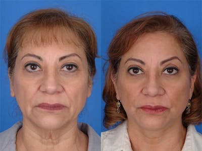 Facelifts Before & After Gallery - Patient 177570562 - Image 1