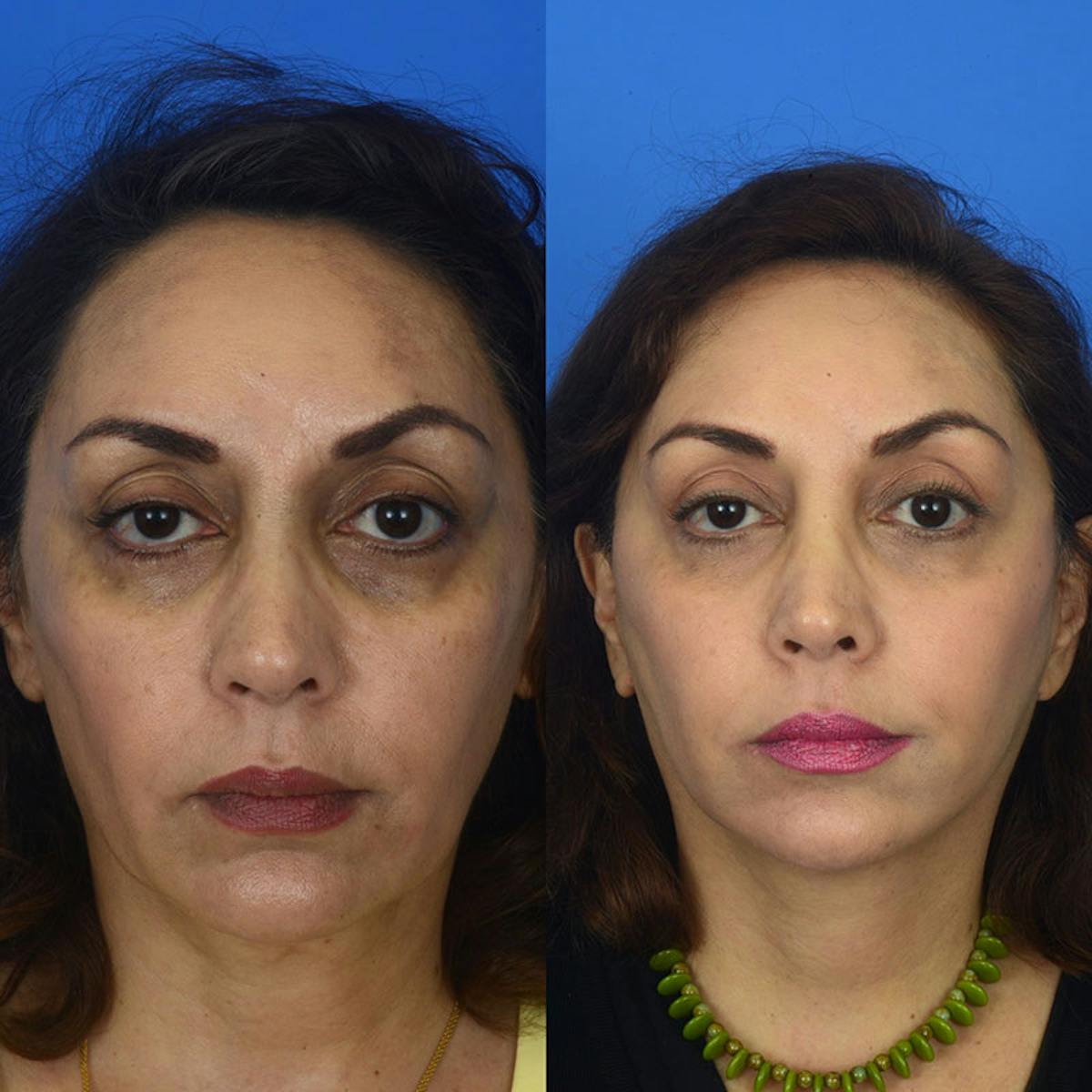 Eyelifts & Blepharoplasty Before & After Gallery - Patient 177570560 - Image 2