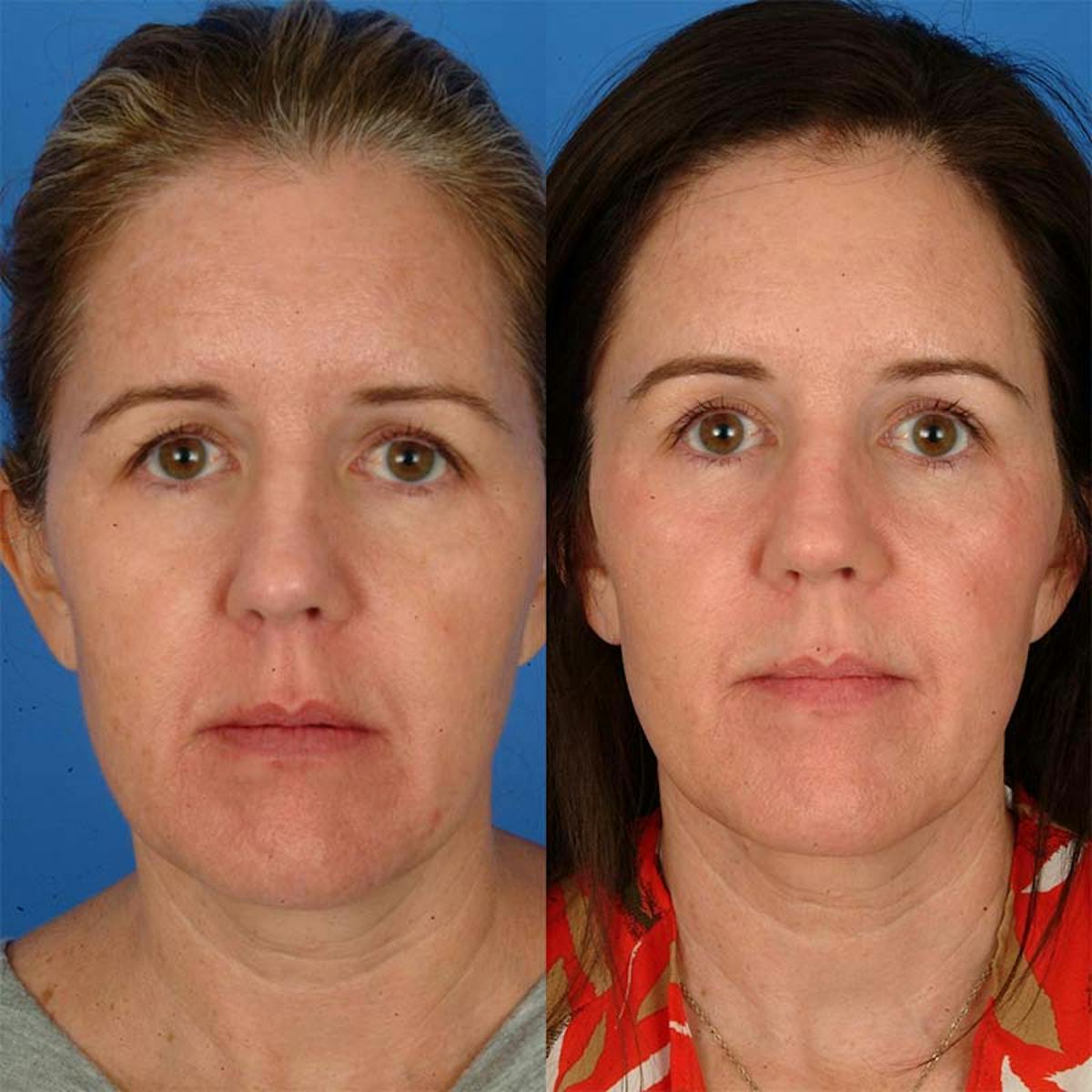 Brow Lifts Before & After Gallery - Patient 177570633 - Image 1