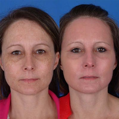 Eyelifts & Blepharoplasty Before & After Gallery - Patient 177570564 - Image 1