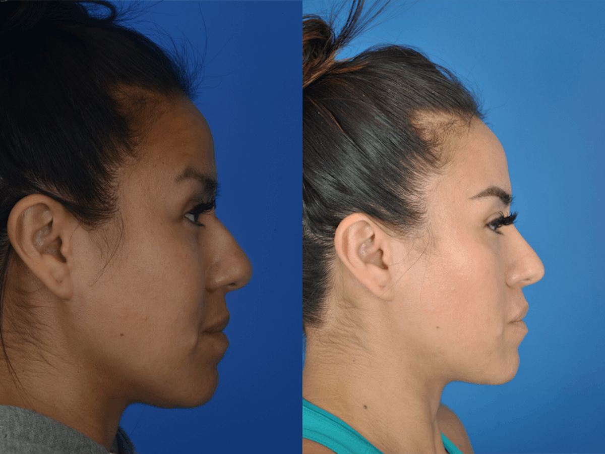 Rhinoplasty Before & After Gallery - Patient 177570563 - Image 1