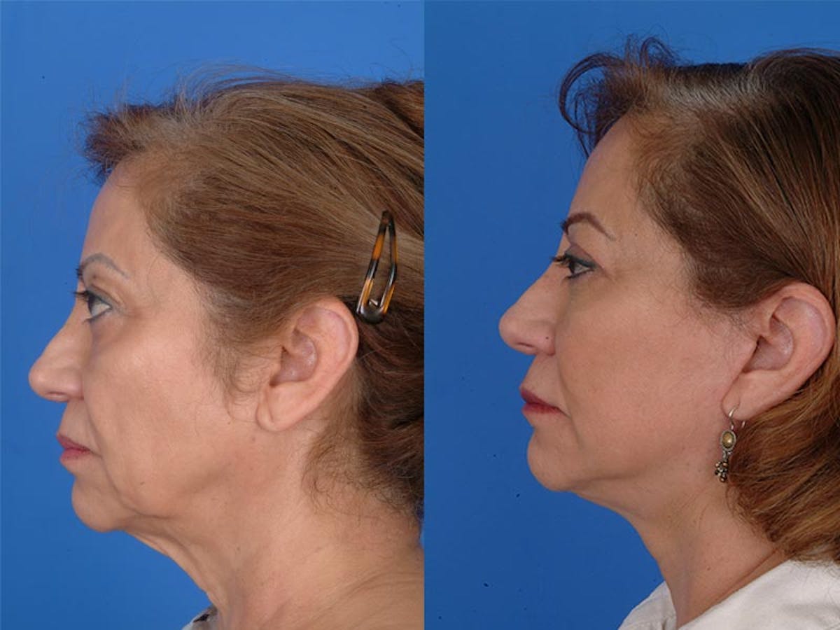 Facelifts Before & After Gallery - Patient 177570562 - Image 2