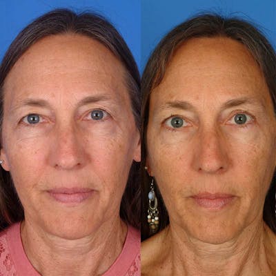 Brow Lifts Before & After Gallery - Patient 177570566 - Image 1