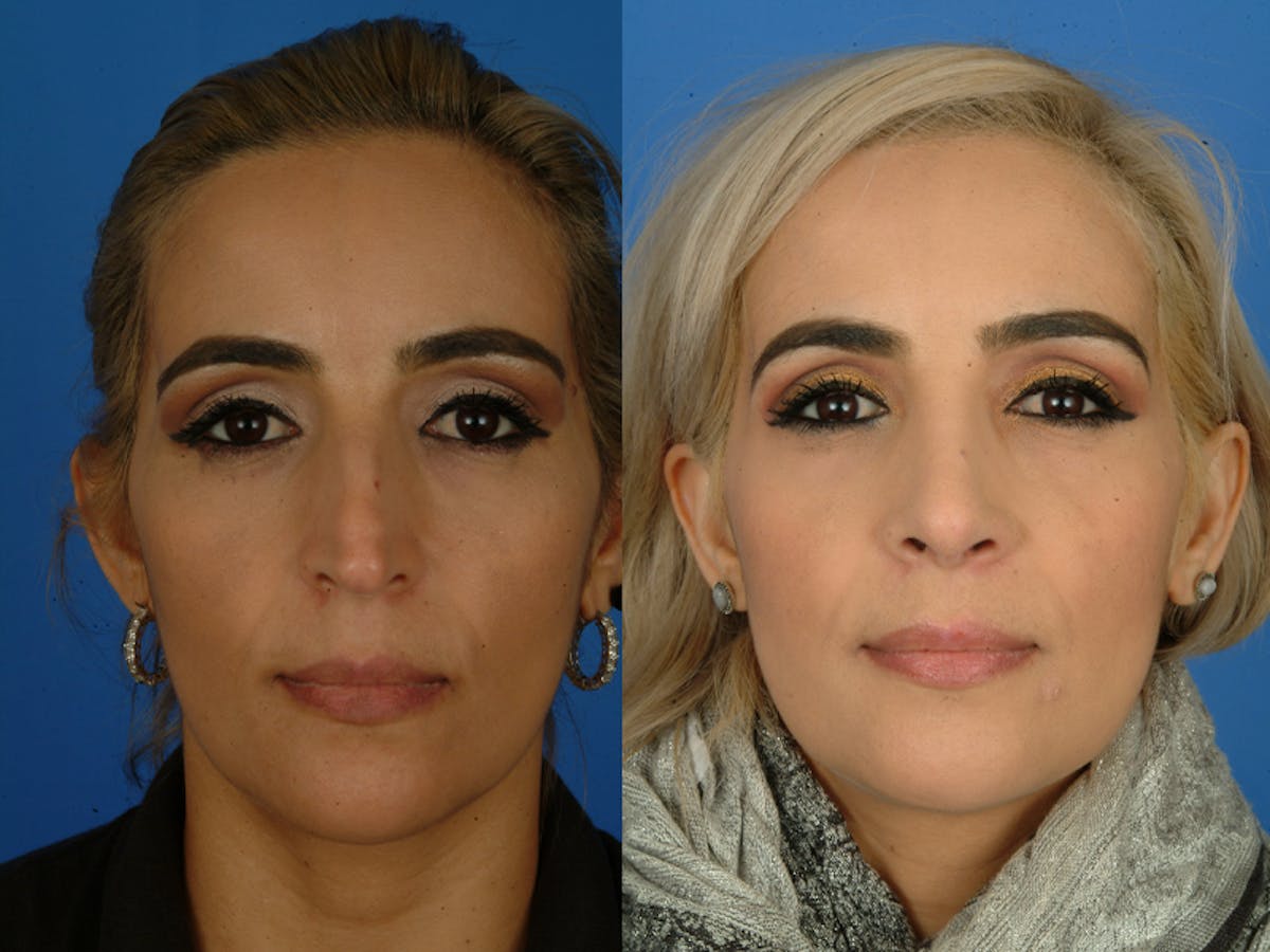 Rhinoplasty Before & After Gallery - Patient 177570569 - Image 2
