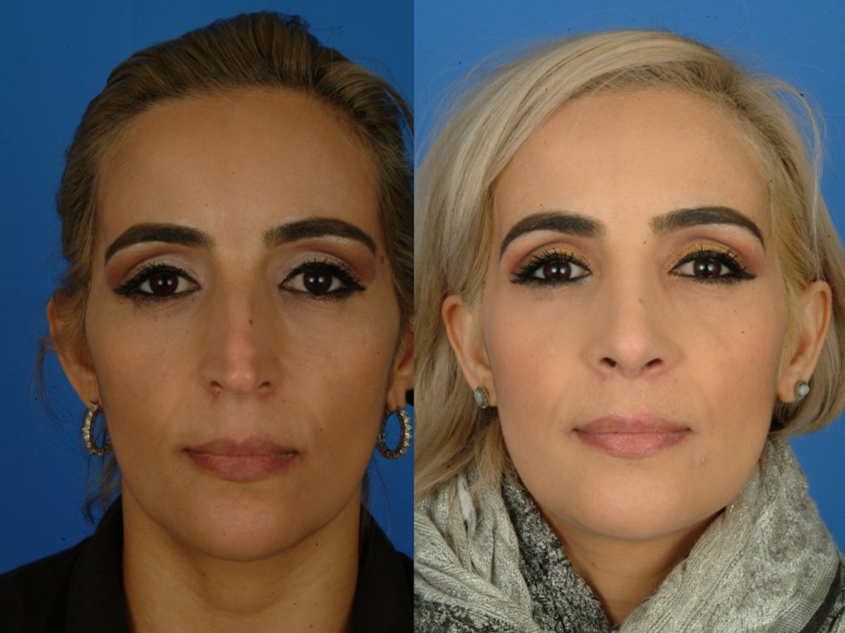 Rhinoplasty Before & After Gallery - Patient 177570569 - Image 1