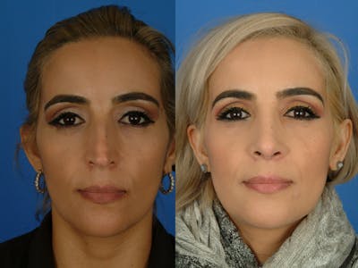 Rhinoplasty Before & After Gallery - Patient 177570569 - Image 1