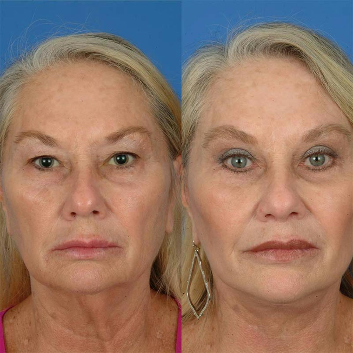 Eyelifts & Blepharoplasty Before & After Gallery - Patient 177570568 - Image 1