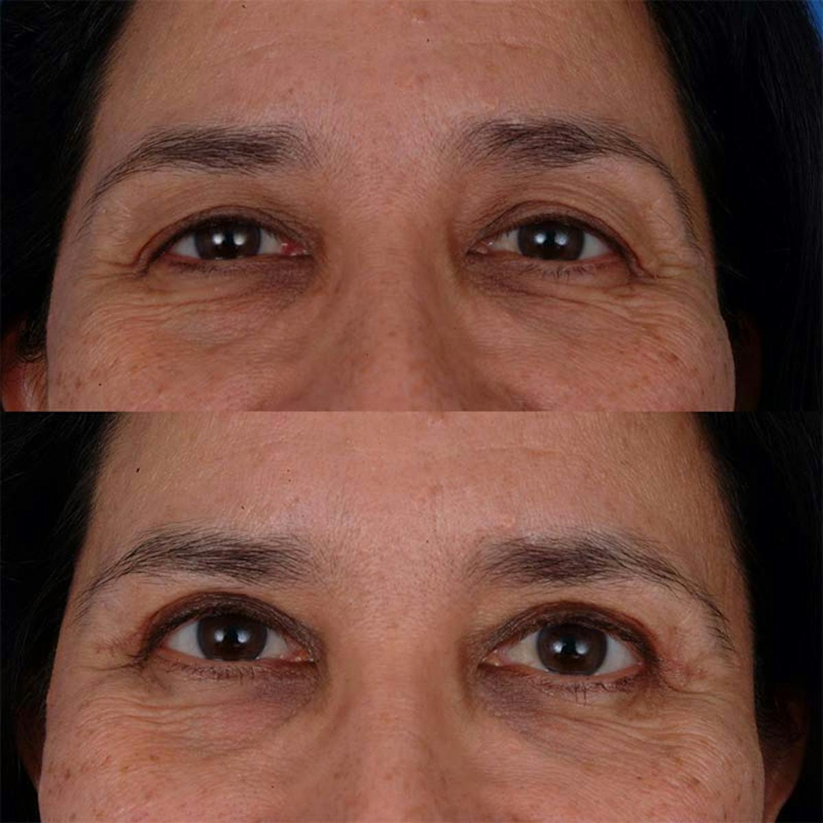 Eyelifts & Blepharoplasty Before & After Gallery - Patient 177570568 - Image 2