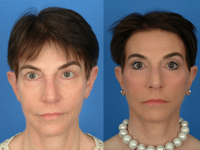 Facelifts Before & After Gallery - Patient 177570570 - Image 1