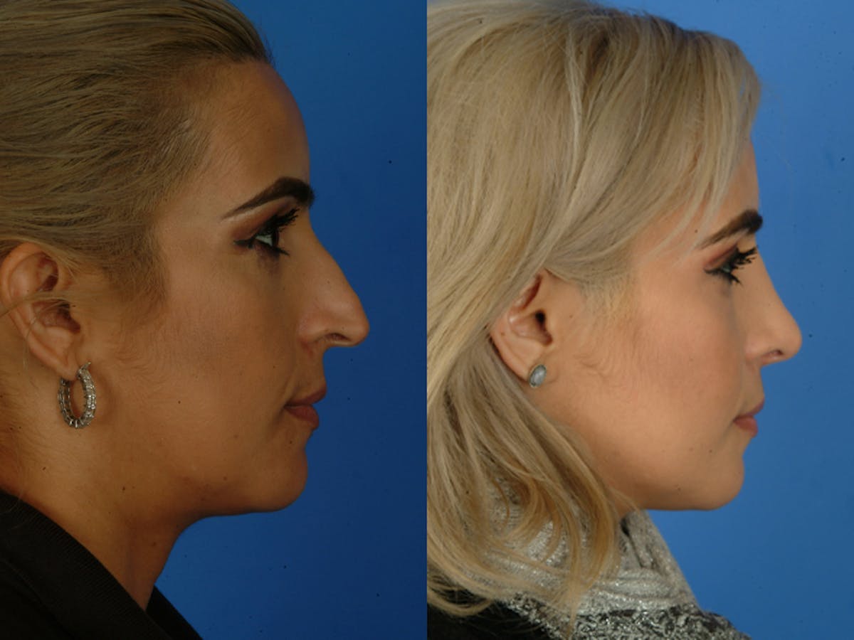 Rhinoplasty Before & After Gallery - Patient 177570569 - Image 2
