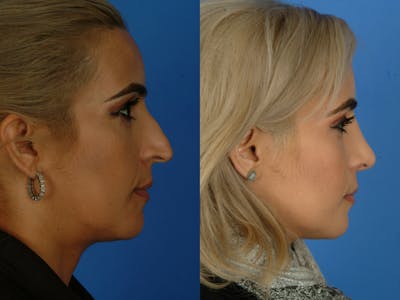 Rhinoplasty Before & After Gallery - Patient 177570569 - Image 1