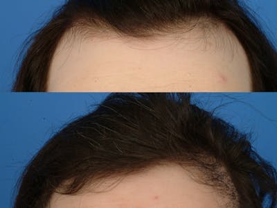 Hair Restoration Before & After Gallery - Patient 177570572 - Image 1