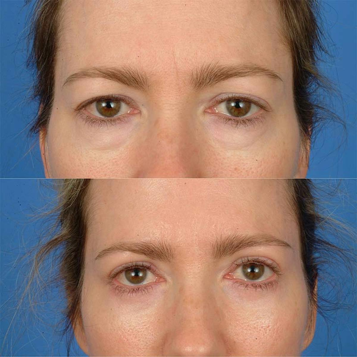 Eyelifts & Blepharoplasty Before & After Gallery - Patient 177570571 - Image 1