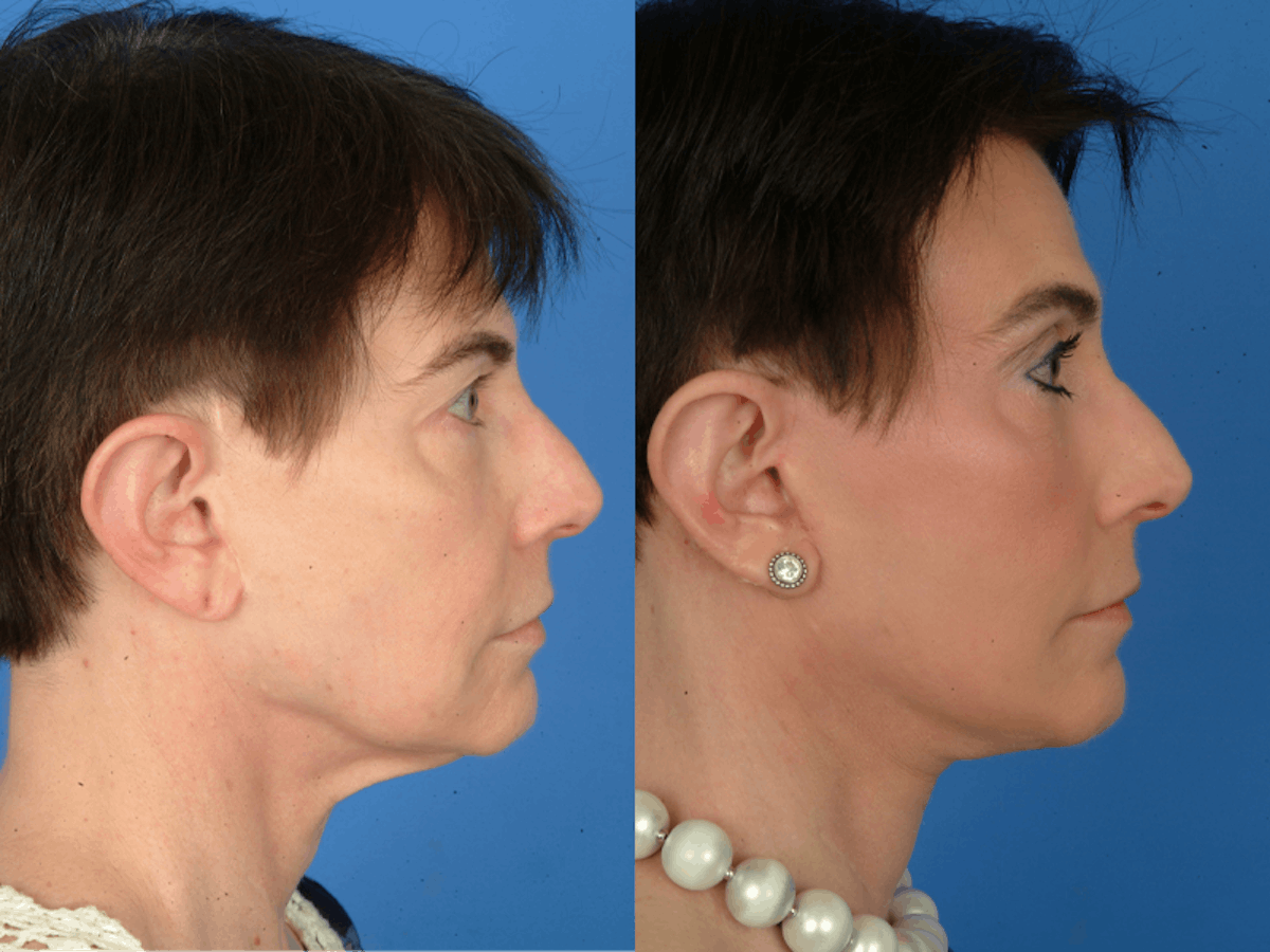 Facelifts Before & After Gallery - Patient 177570570 - Image 2
