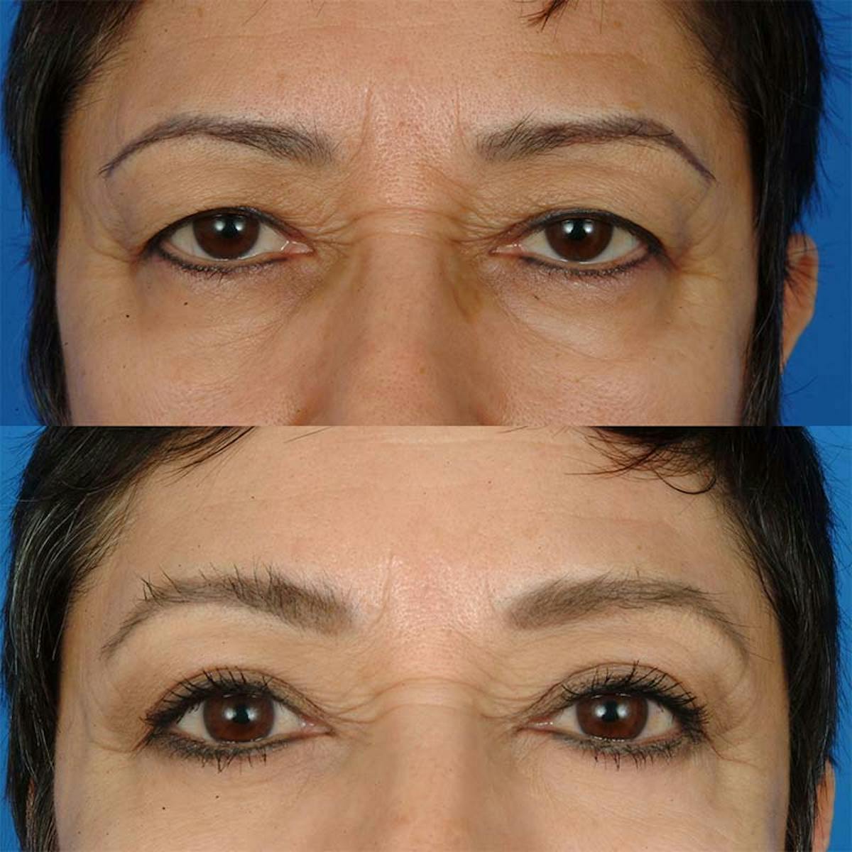 Eyelifts & Blepharoplasty Before & After Gallery - Patient 177570571 - Image 2