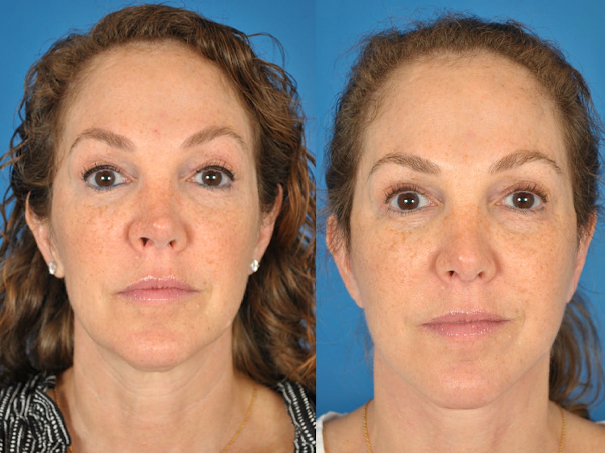 Rhinoplasty Before & After Gallery - Patient 177570573 - Image 2