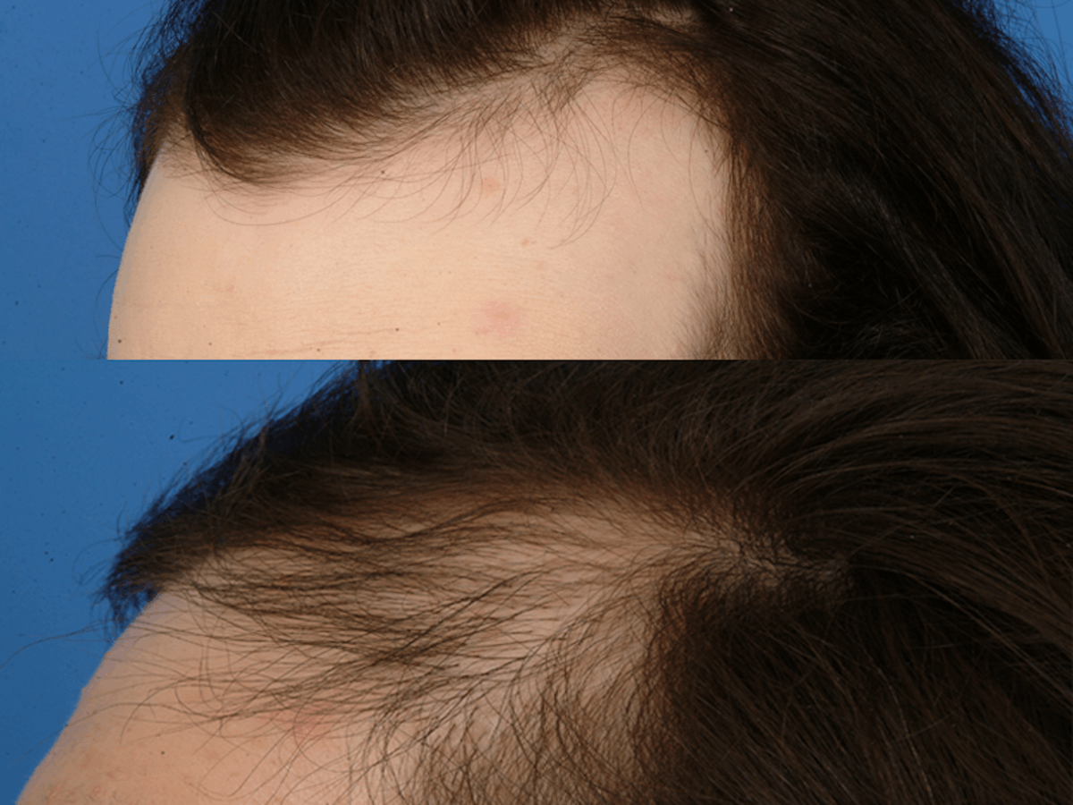 Hair Restoration Before & After Gallery - Patient 177570572 - Image 2