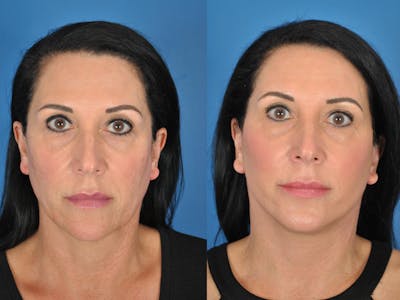 Facelifts Before & After Gallery - Patient 177570575 - Image 1