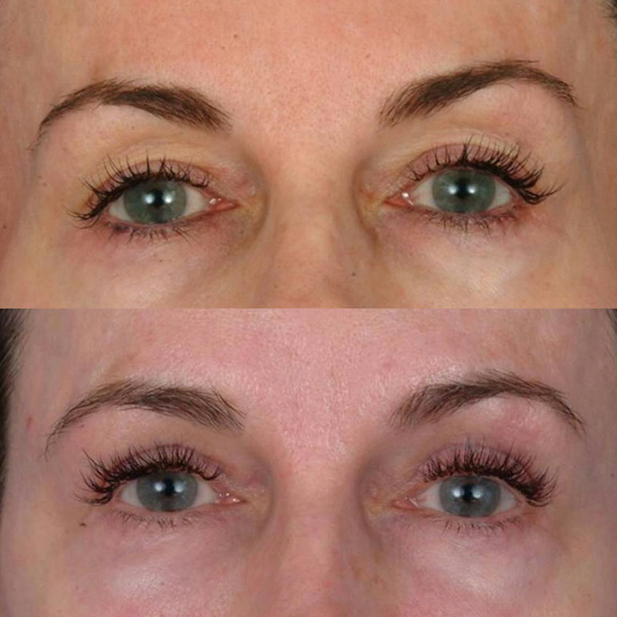 Eyelifts & Blepharoplasty Before & After Gallery - Patient 177570576 - Image 1