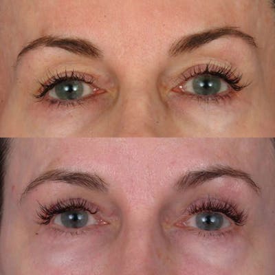 Eyelifts & Blepharoplasty Before & After Gallery - Patient 177570576 - Image 1